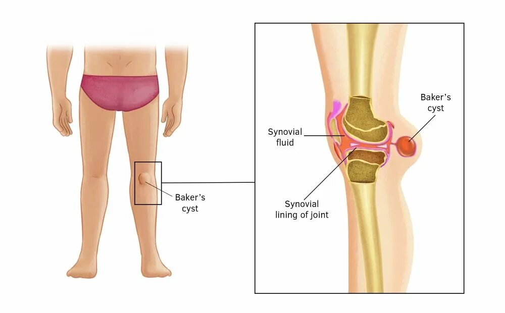 Почему болит кость ноги спереди. Киста Бейкера коленного сустава. Шишки под коленным суставом.