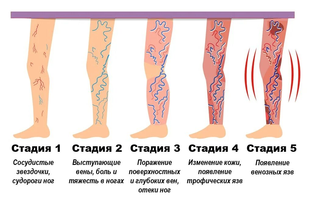 Тромбофлебит вен конечностей симптомы. Тромбофлебит поверхностных вен голени. Тромбоз поверхностных вен нижних конечностей. Тромбоз вен нижних конечностей симптомы. Тромбоз вен нижних лекарства