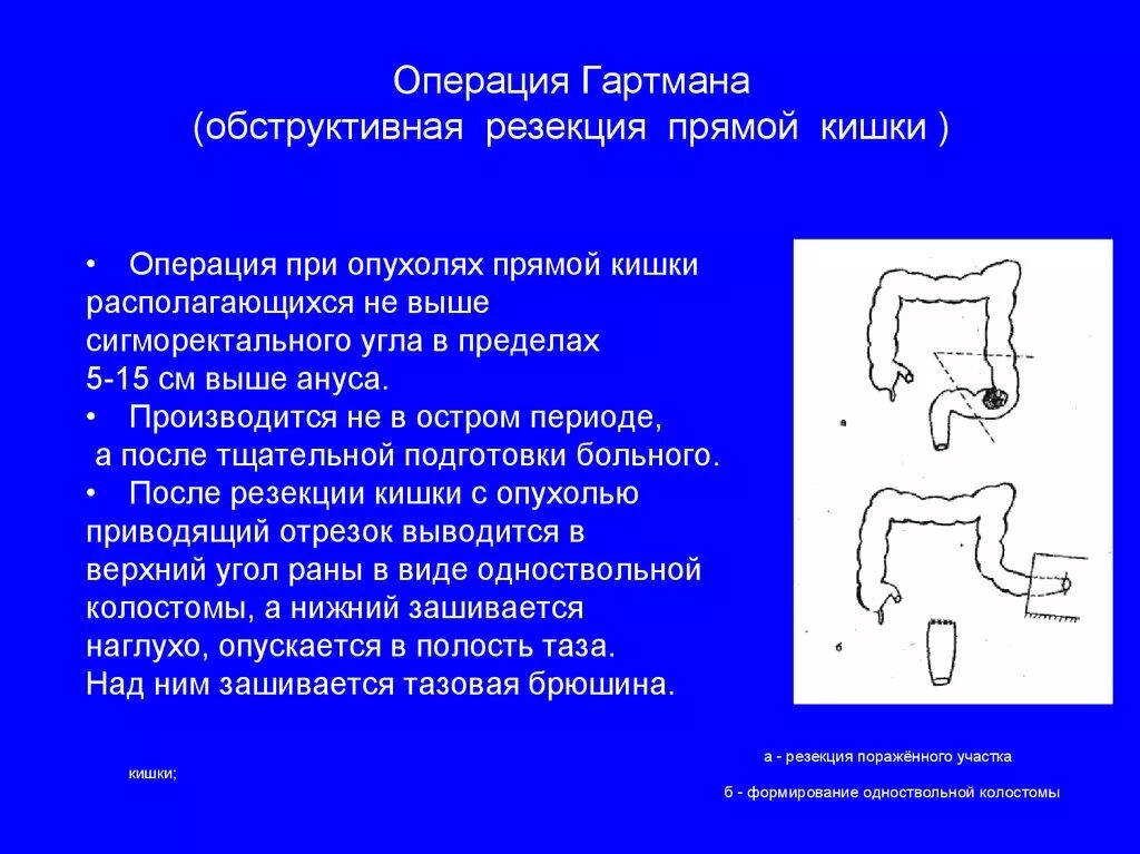 Операция Гартмана опухоли кишки. Операция Гартмана прямой кишки схема. Передняя резекция прямой кишки схема. Операция Гартмана и низкая передняя резекция прямой кишки. Операции через прямую кишку