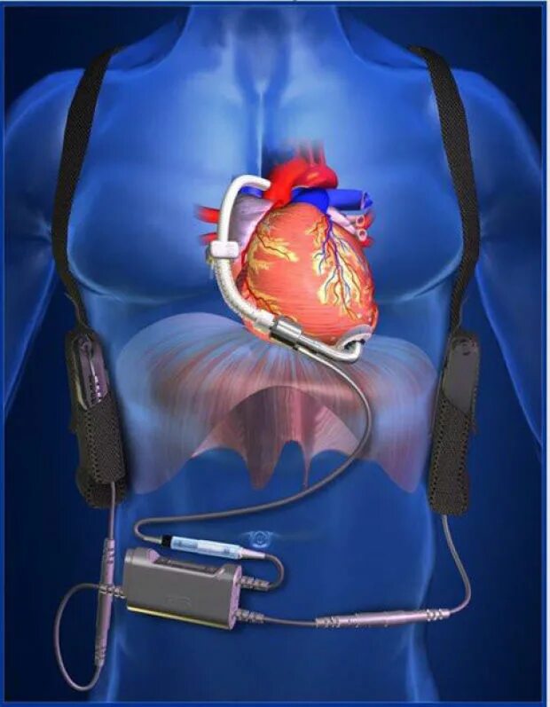 Сколько весит искусственный левый желудочек для сердца. Искусственный левый желудочек. Искусственное сердце. Искусственный желудочек сердца. Искусственный левый желудочек сердца.