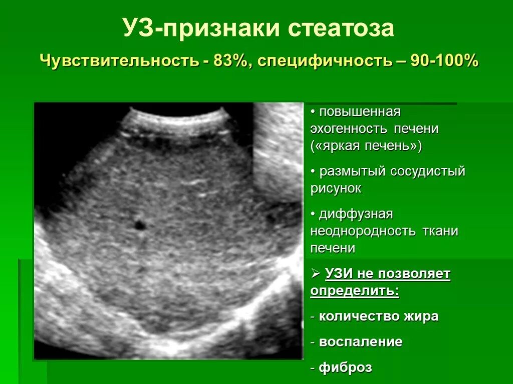 Признаки стеатоза печени. УЗИ жирового гепатоза печени. УЗИ признаки стеатоза печени.