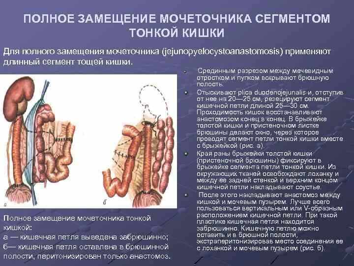 Сегмент кишка. Замещение мочеточника сегментом тонкой кишки. Пластика мочеточника кишечником.