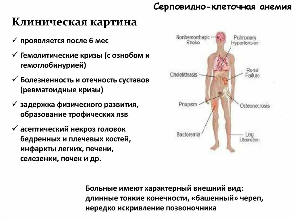 Анемия наследуется. Серповидноклеточная анемия клиническая картина. серповидная клеточная анемия симптомы. серповидно клеточная анемия клиника. серповидноклеточная анемия основные клинические проявления.