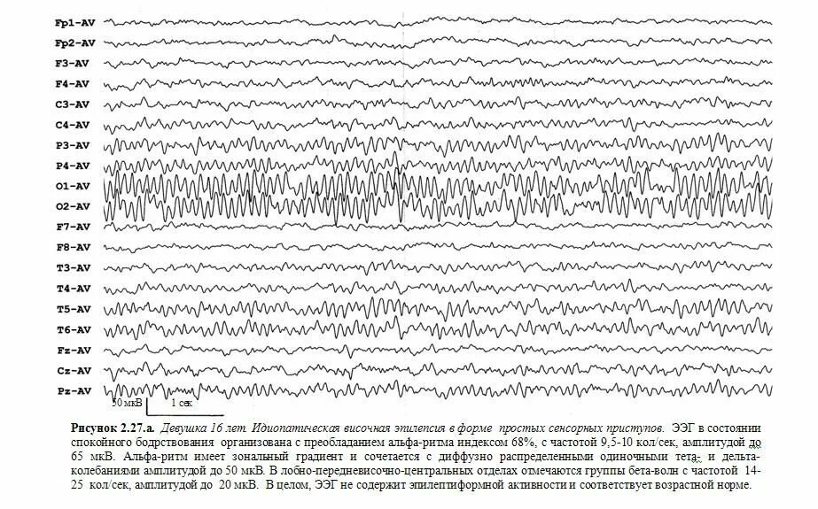 Ээг возраст. Вспышки Дельта волн на ЭЭГ. Патологические ритмы ЭЭГ. Гамма ритм ЭЭГ. Альфа активность на ЭЭГ.