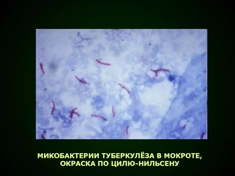 Мокрота какие бактерии. Микобактерии туберкулеза в мокроте окраска по цилю нильсену. туберкулёзная палочка в мокроте по цилю нильсену. палочки туберкулеза по цилю-нильсену. палочка коха по цилю нильсену.