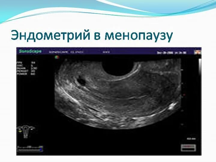 Эндометрий 7 5. Норма толщины эндометрия при УЗИ матки. Патология эндометрия в менопаузе на УЗИ. Эндометрия матки УЗИ гиперплазия эндометрия. Эндометрий в менопаузе на УЗИ.