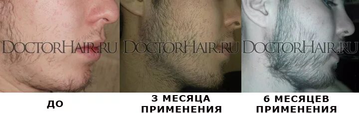four times Strait thong Team up with how to apply minoxidil for beard prediction