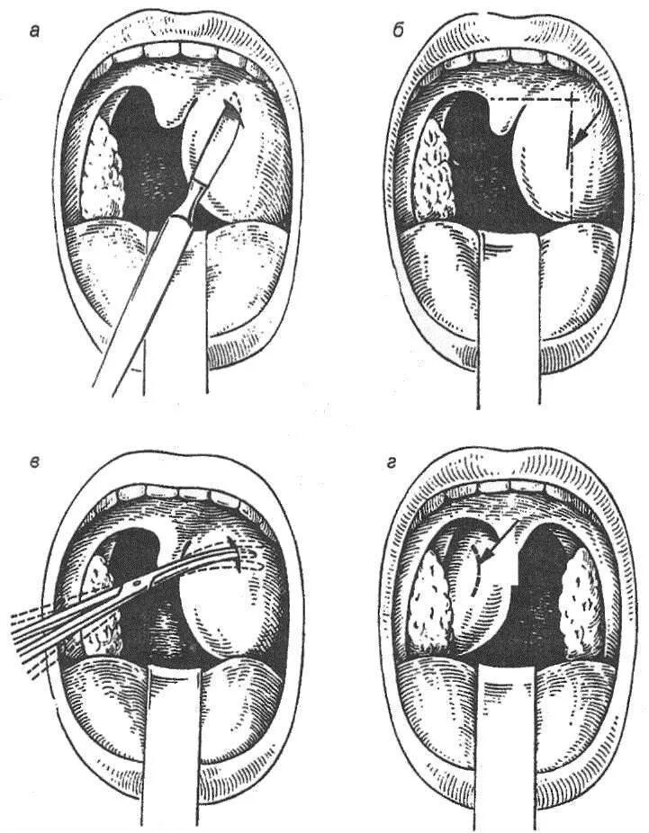 Интратонзиллярный абсцесс. Паратонзиллярный абсцесс вскрытие. Внутриминдаликовый абсцесс. Хронический тонзиллит паратонзиллярный абсцесс. Гнойный н