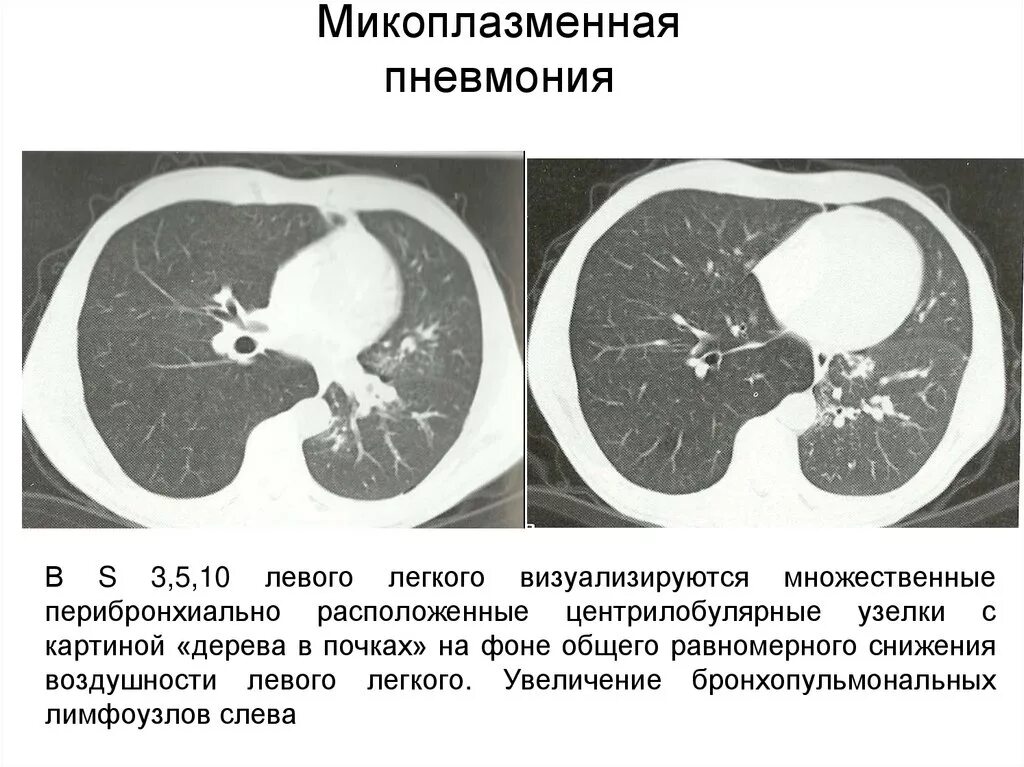 Дерева в почках в легких кт. Микоплазменная пневмония на кт. Микоплазменная пневмония на кт легких. Рентгенограмма микоплазменной пневмонии. Пневмония на кт.