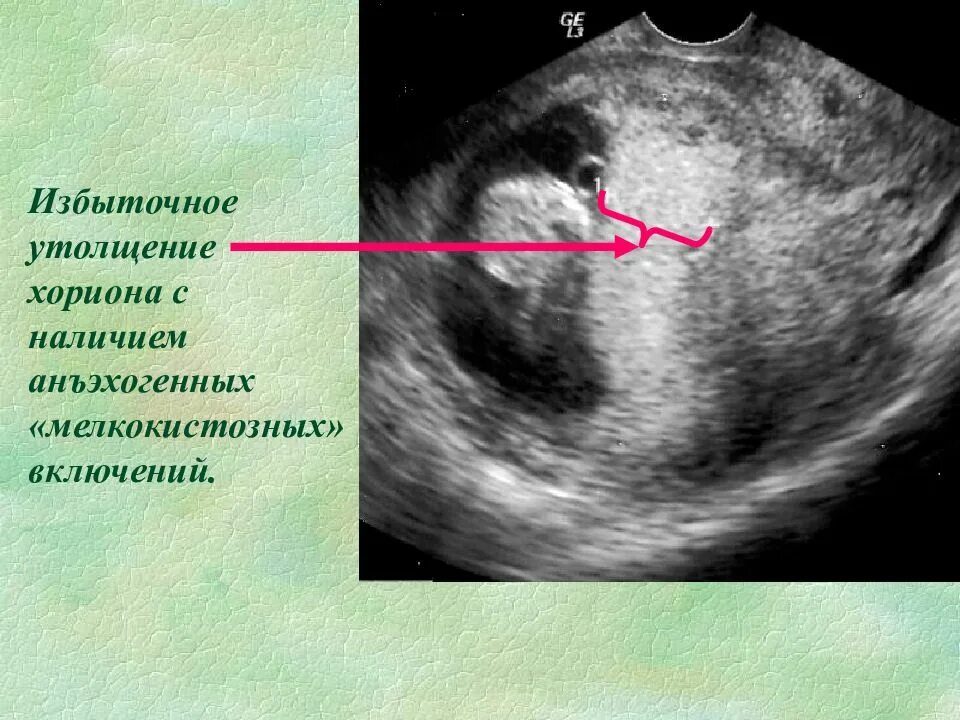 Диффузное утолщение