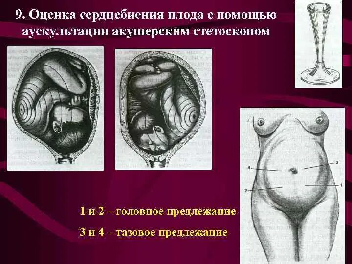Норма сердцебиения плода в родах. Сердцебиения плода алгоритм. Чсс плода 12 недель беременности норма. Методика аускультации сердцебиения плода. Сердцебиения плода алгоритм.
