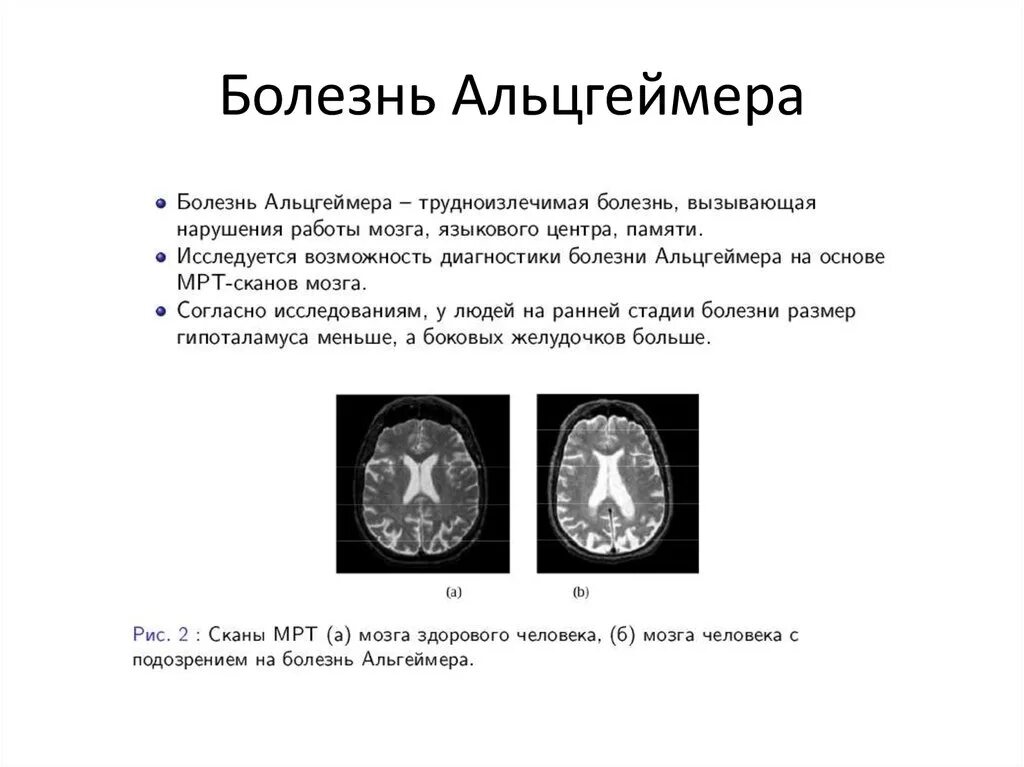 Атрофия головного мозга лечение. Кт и мрт при болезни Альцгеймера. Болезнь Альцгеймера на кт. Мрт головного мозга болезнь Альцгеймера. Мрт головного мозга при болезни Альцгеймера.