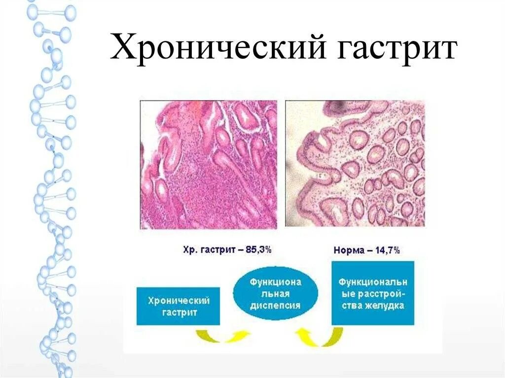 Хронический гастрит гистология. Атрофический гастрит патанатомия. Хронический поверхностный гастрит. Гастрит, хронический гастрит. Обострение атрофического гастрита