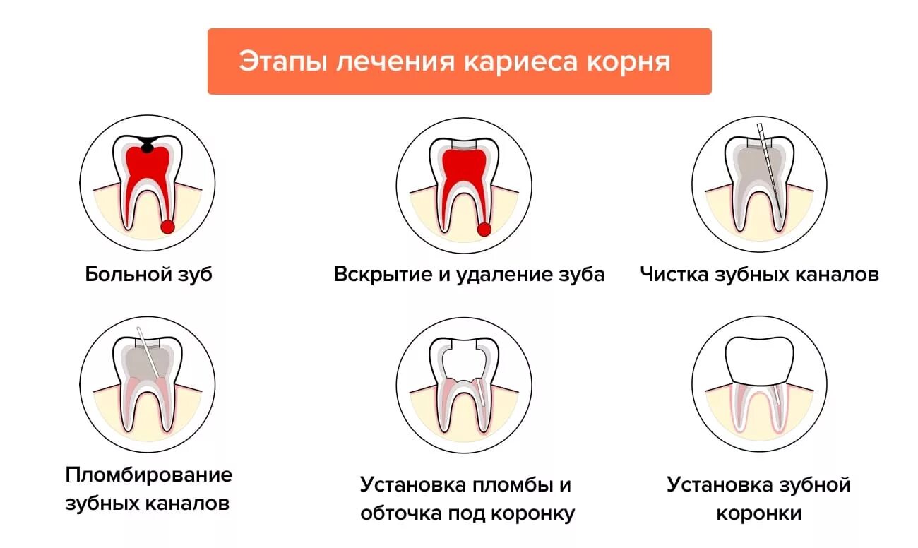 Причины кариеса зубов схема. Кариес корня зуба схема. Степени развития кариеса.