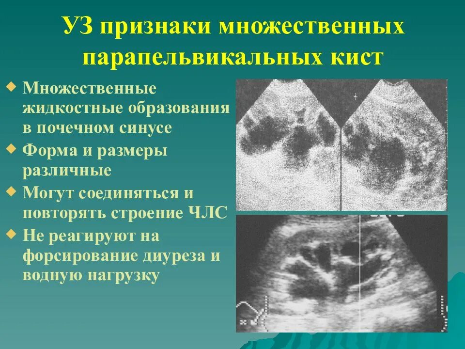 Изменение синусов обеих почек. Перипельвикальные кисты почек на УЗИ. Кисты почечного синуса УЗИ. Синусные кисты почек на УЗИ.