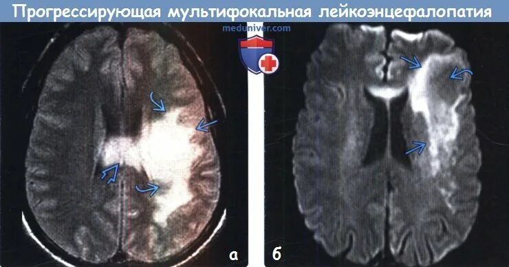 Многоочаговое поражение мозга. ПМЛ мрт прогрессирующая мультифокальная лейкоэнцефалопатия. Прогрессирующая мультифокальная лейкоэнцефалопатия мрт. Прогрессирующая мультифокальная лейкоэнцефалопатия кт. Мультифокальное поражение головного мозга мрт.