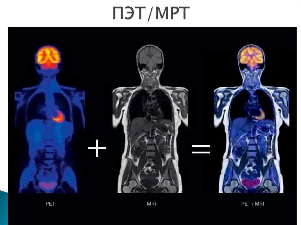 Позитрон-эмиссионная  томография: ПЭТ. Позитронно-эмиссионная томография (ПЭТ) снимки. ПЭТ кт исследование онкология. Пэт кт или кт что лучше