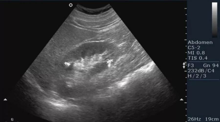 Кальцинат в правой доле. Кальцинат паренхимы почки на УЗИ. Кальцинаты в паренхиме почки УЗИ. Микрокальцинаты в паренхиме почек. Микрокальцинаты в почках на УЗИ.