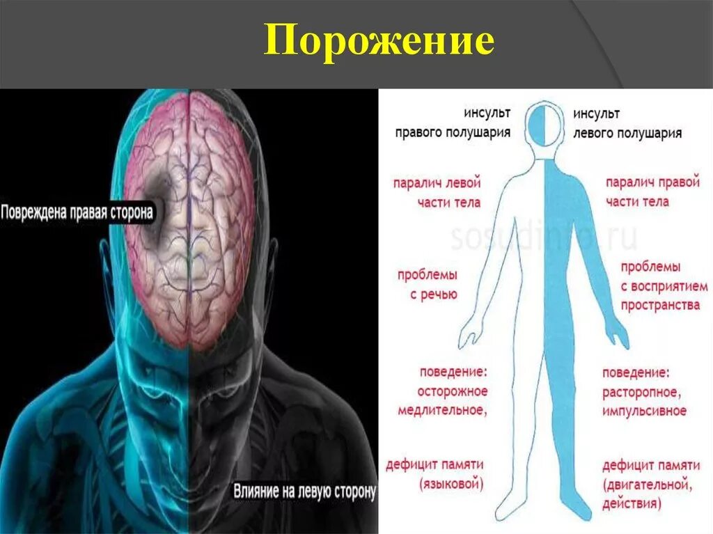 Инсульт парализация левой стороны. Инсульт правого полушария головного мозга. Ишемический инсульт головного мозга правая сторона. Инсульт в правом полушарии. Инсульт мозга последствия.