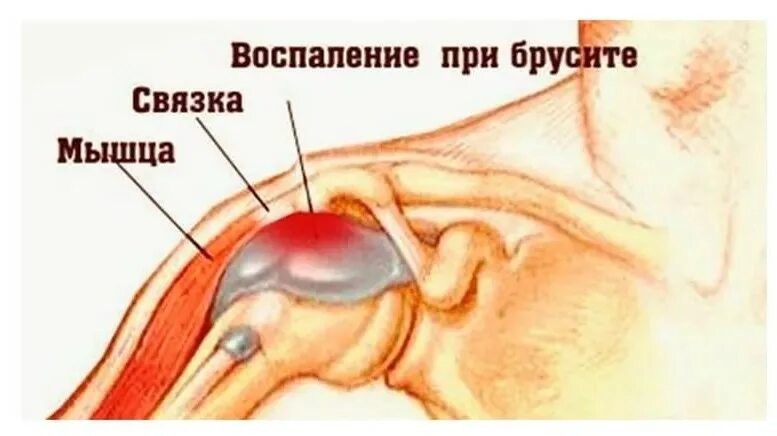 Как лечить бурсит сустава. Субдельтовидный бурсит плечевого сустава. субдельтовидный субакромиальный бурсит плечевого сустава. субакромиальная бурса плечевого сустава. известковый бурсит плечевого сустава.
