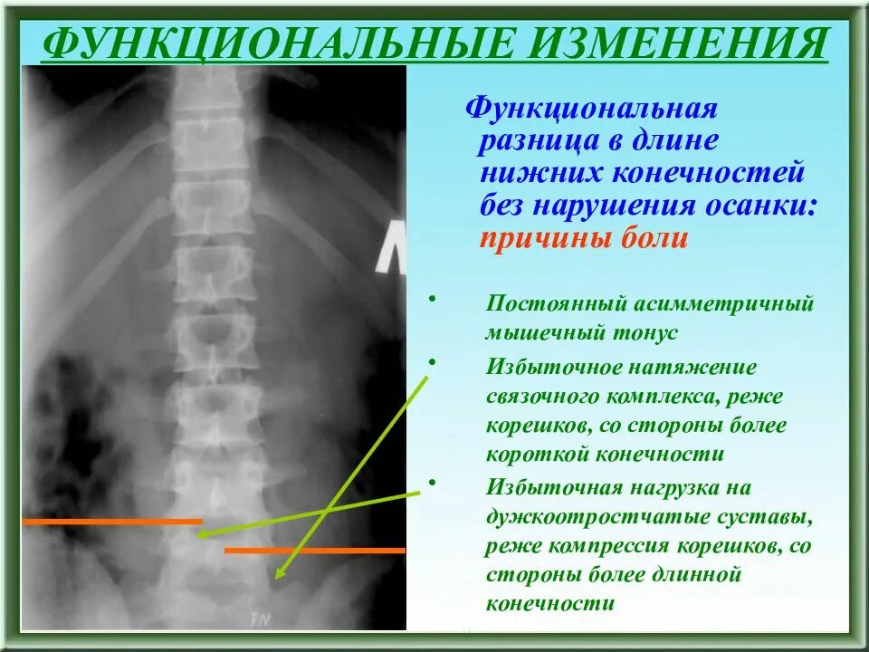 Функциональная боль причины. Длина и ширина. Разница длиною. Ширина. Подобрать беговые лыжи для конькового хода.
