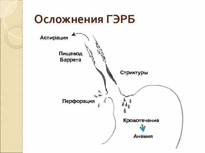 Рефлюкс заброс. Гастроэзофагеальный рефлюкс болезнь осложнения. Гастроэзофагеальная рефлюксная болезнь осложнения. Осложнения гастроэзофагеальной рефлюксной болезни. Осложнением ГЭРБ является:.