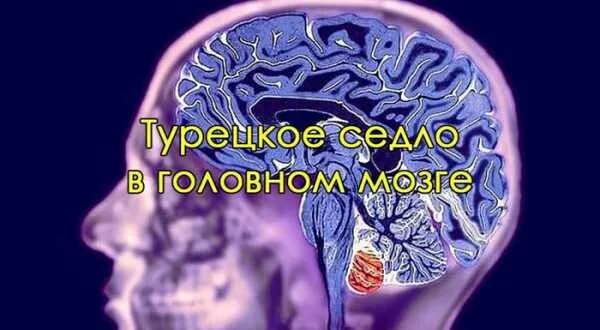 Формирующееся турецкое седло в головном мозге