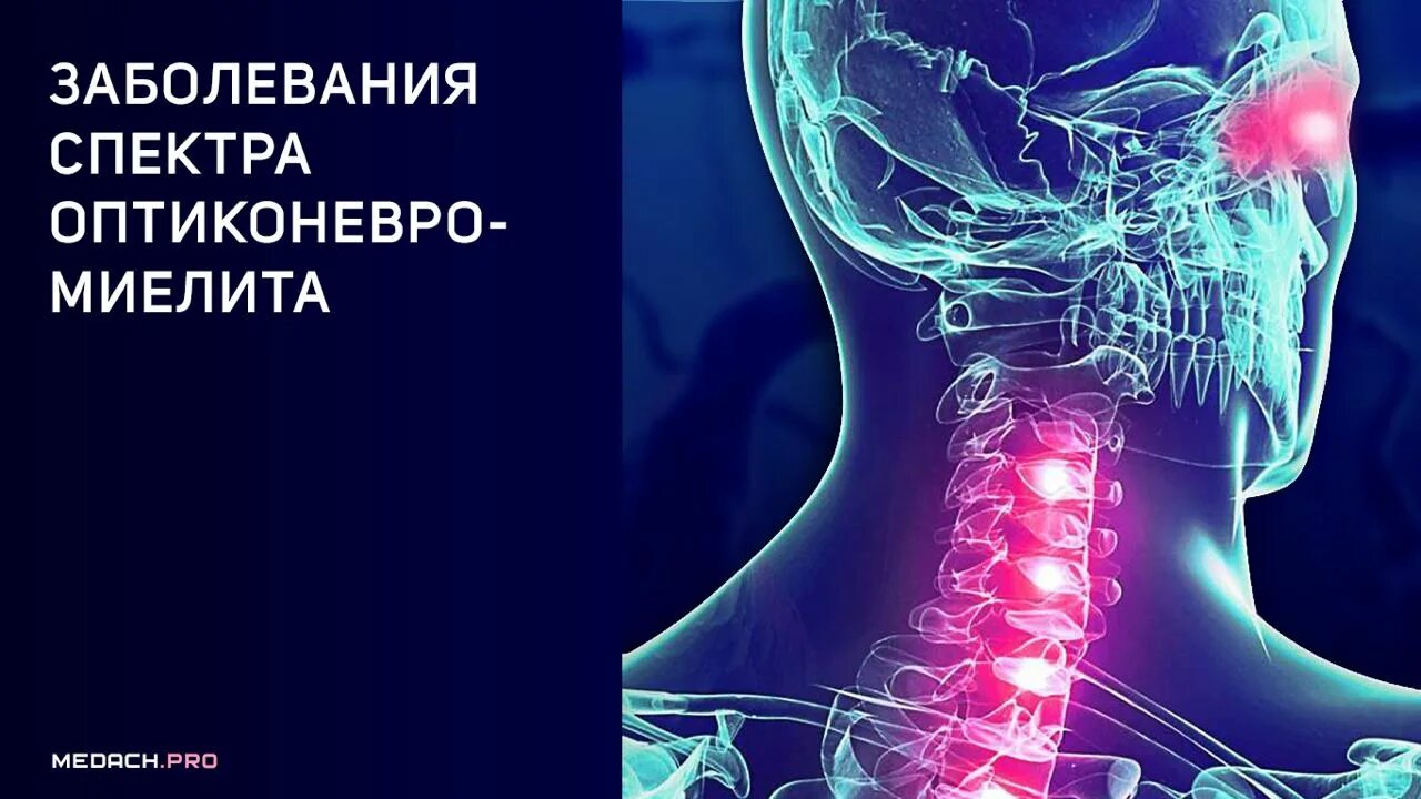 Оптикомиелит мрт. Заболевание спектра оптиконевромиелита. Нейромиелит девика. Оптикомиелит девика. Оптикомиелит девика.