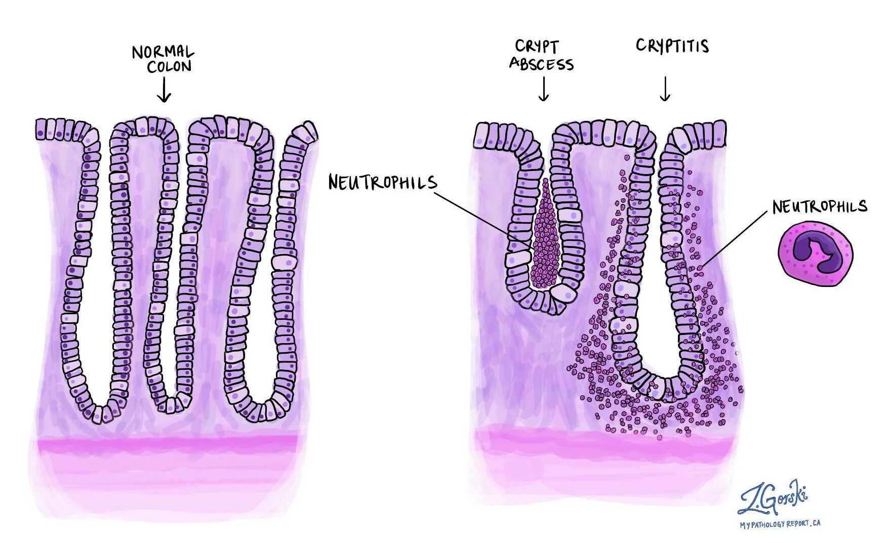 Крипт абсцессы при язвенном колите. Крипт абсцессы. Хронический энтерит гистология. Изменения в слизистой кишечника. Язвенный колит макропрепарат.