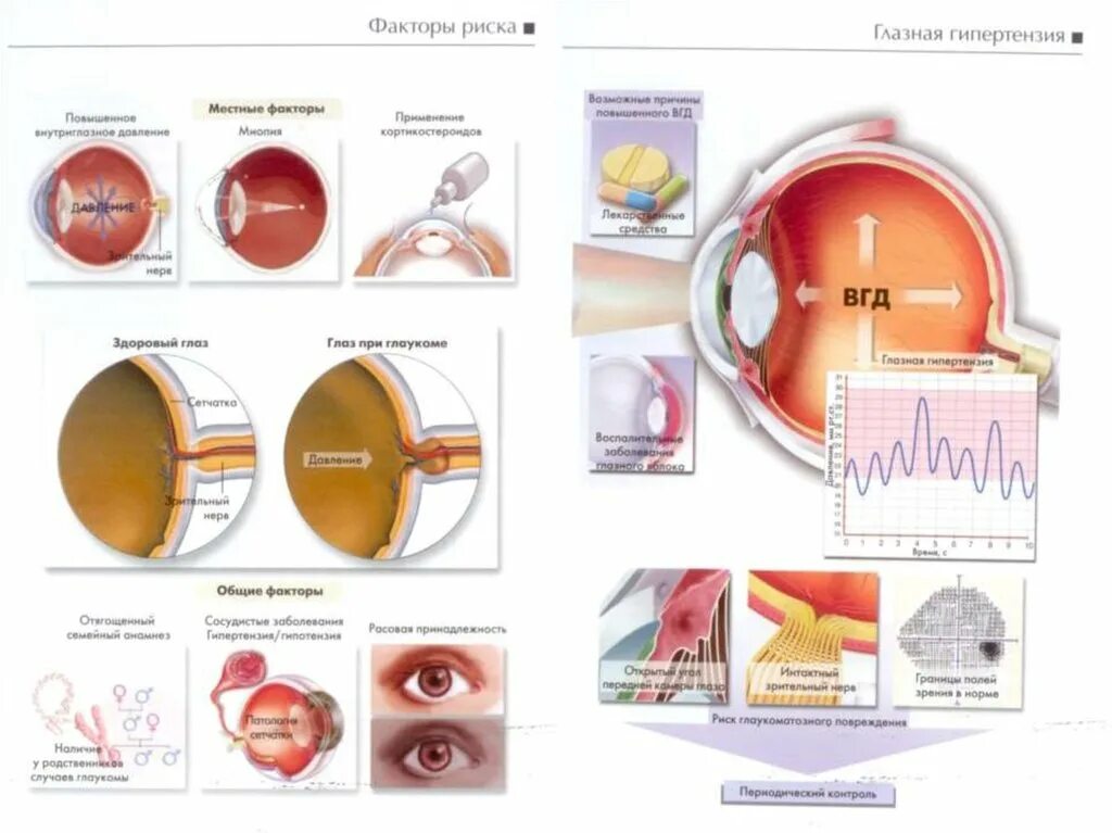 Внутриглазное давление лечение у взрослых. Глаукома схема глаза. Внутриглазное давление глаукома.