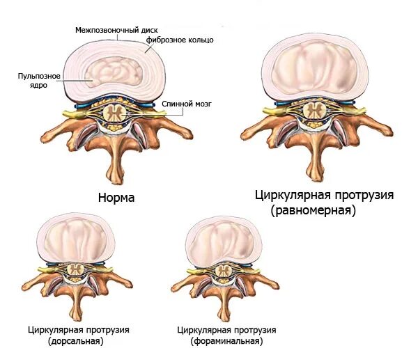 Циркулярная грыжа диска. Дорзальная диффузная протрузия. Дорзальная диффузная протрузия межпозвонкового диска l5-s1. Дорзальные протрузии дисков это грыжа?. Циркулярное выбухание диска l4/l5.