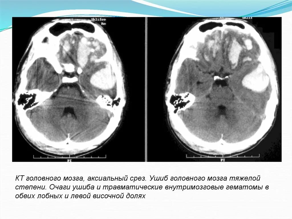 Диффузная церебральная. Мрт головного мозга при ЧМТ. Ушиб головного мозга тяжелой степени кт. Черепно мозговая травма кт и мрт.