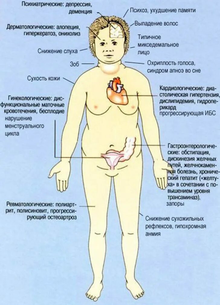 Заболевания эндокринной систему щитовидной железа. Первичный гипотиреоз щитовидной железы. Последствия гипотиреоза у женщин