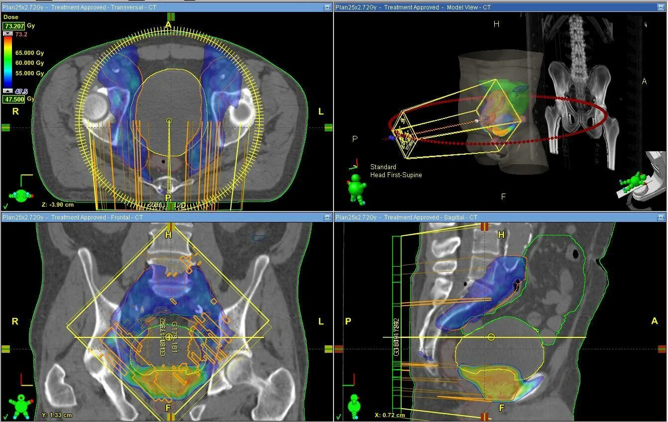 Трехмерное планирование лучевой терапии. Трехмерная конформная лучевая терапия. IGRT лучевая терапия. Кт планирование для лучевой терапии. Онкология простаты лучевая