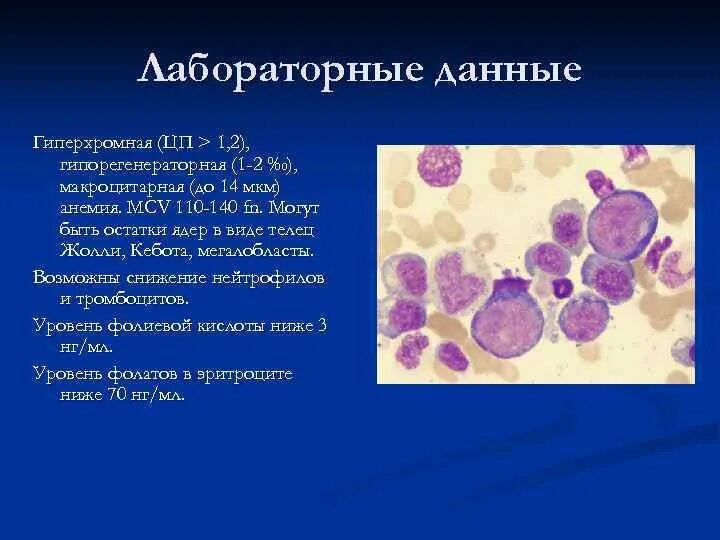 Мегалобласты норма в крови. Гиперхромная мегалобластная анемия. Анализ при гиперхромной анемии. Гипо и гиперхромная анемия. Клетки с гиперхромными ядрами