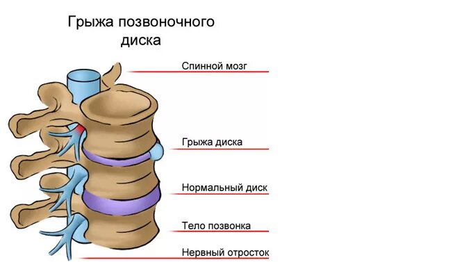 Симптомы межпозвоночной грыжи. Грыжа поясничного отдела позвоночника анатомия. Грыжа поясничного отдела позвоночника строение. Грыжа грудного отдела позвоночника. Грыжа и протрузия поясничного отдела позвоночника.