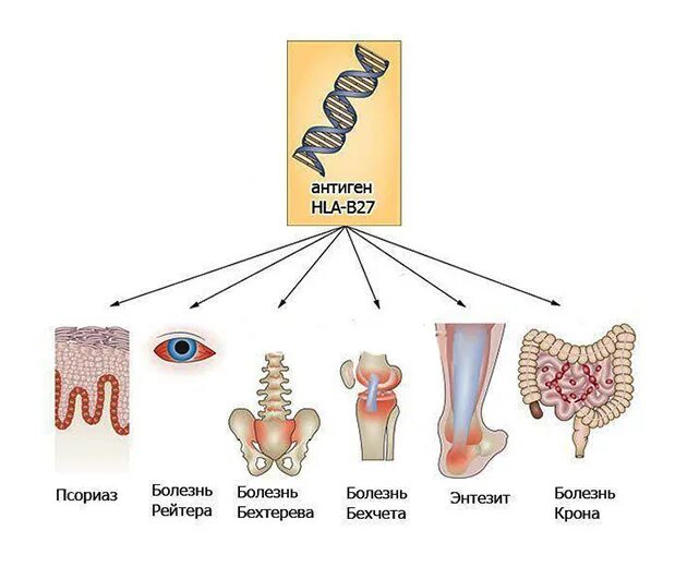 Болезнь рейтера что это. Болезнь Бехтерева антиген HLA b27. Болезнь Рейтера этиология. Болезнь Рейтера патогенез. Клинические проявления синдрома Рейтера.