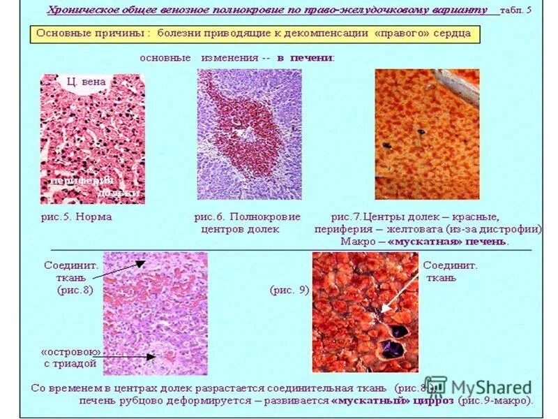Мелкоузловой цирроз гистология. Ткань поджелудочной железы гистология. Алкогольный монолобулярный цирроз печени микропрепарат. Интоксикация цирроз печени. Цирроз печени гистология.