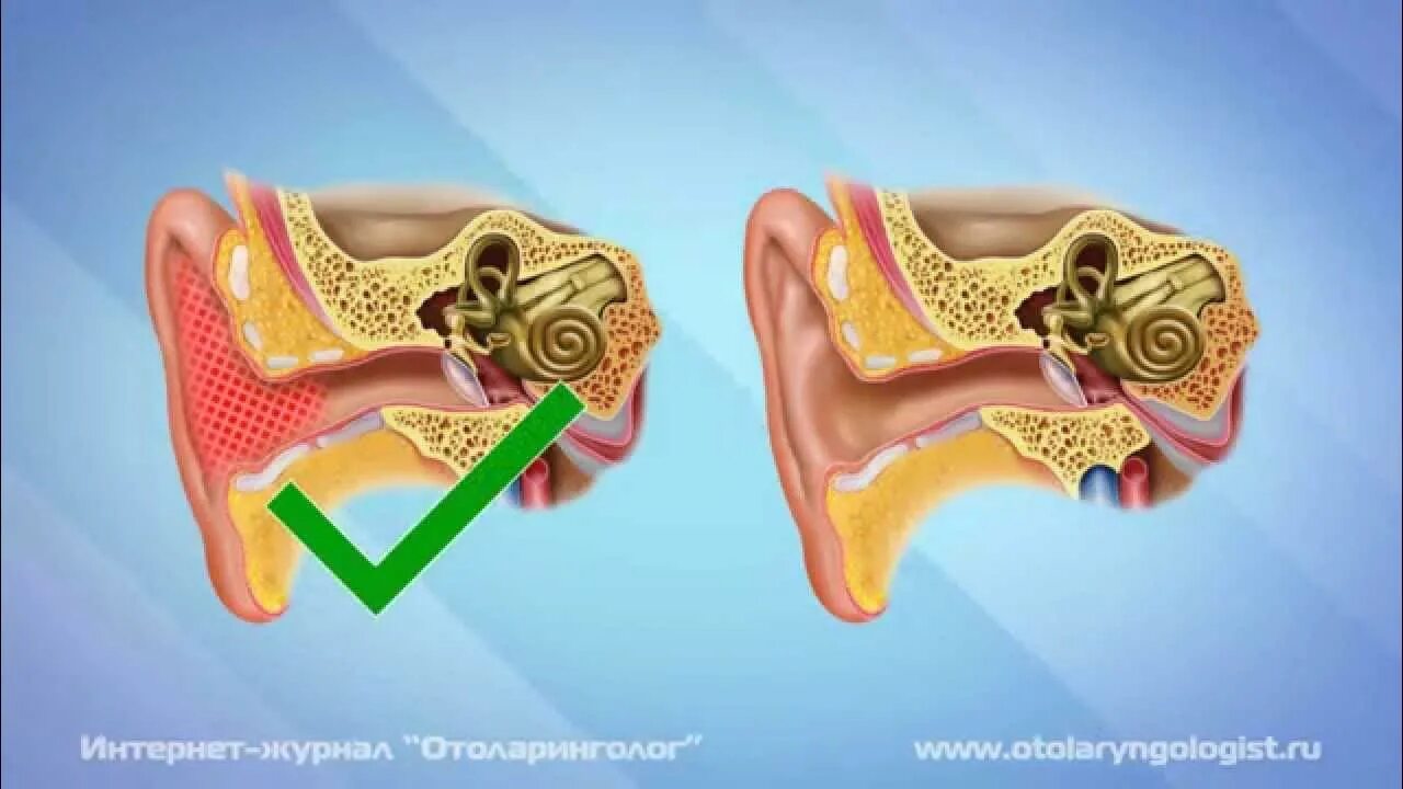 Почему образуются серные. Строение уха серная пробка. Ухо серная серная пробка. Анатомия уха серная пробка.