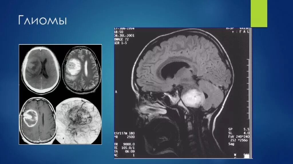 Глиома опухоль головного мозга симптомы. Глиома (астроцитома, эпендимома). Глиома ствола мозга мрт. Глиальная опухоль головного