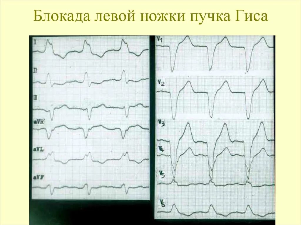 Блокада левой ножки пучка гиса на экг. Неполная блокада левой ножки пучка Гиса на ЭКГ. Неполная блокада ЛНПГ на ЭКГ. Неполная блокада левой ножки на ЭКГ. Не полная блокада левой ножки пучка Гиса.