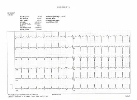 Ein unauffälliges 12-Kanal-EKG 