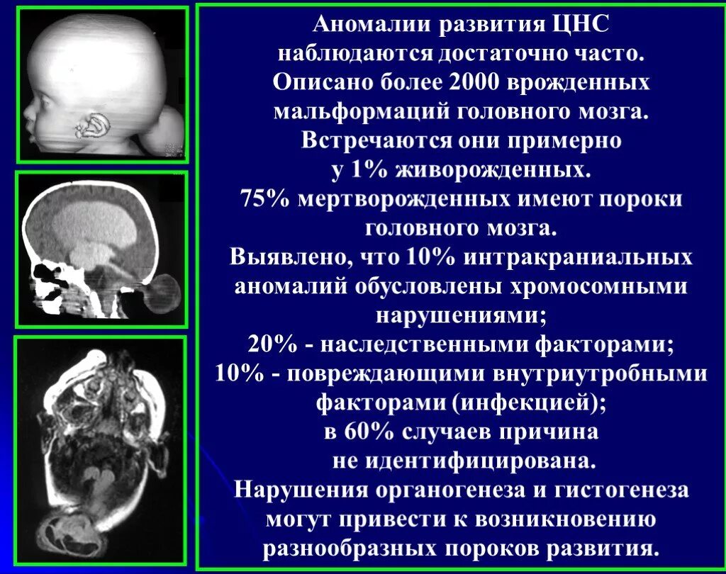 Внутриутробное недоразвитие головного мозга. Врожденные аномалии ЦНС. Пороки развития головного могза. Порог развития головного мозга.