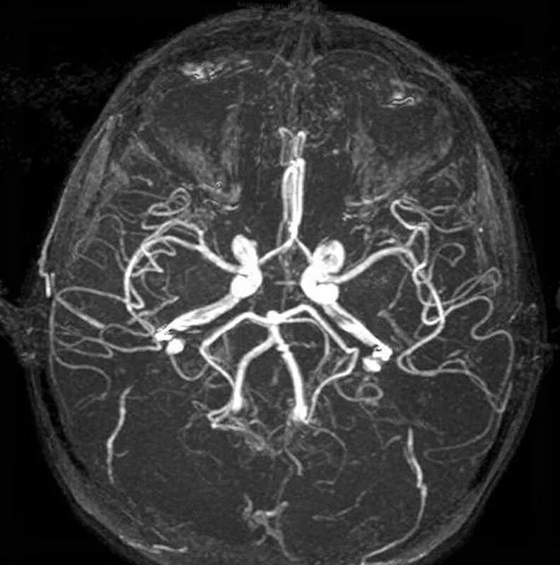 Мрт с контрастом головного. Магнитно резонансные томограммы головного мозга. Венография головного мозга мрт. Мрт ангиография артерий головного мозга. Мрт ангиография вен головного мозга.