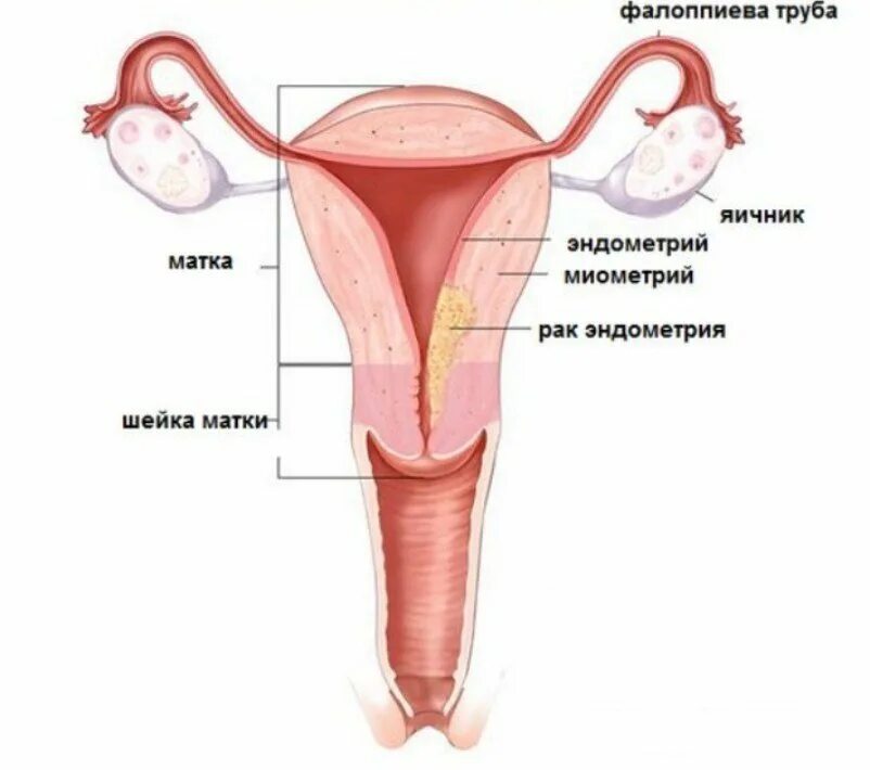 Злокачественное новообразование эндометрия. Злокачественные опухоли эндометрия.