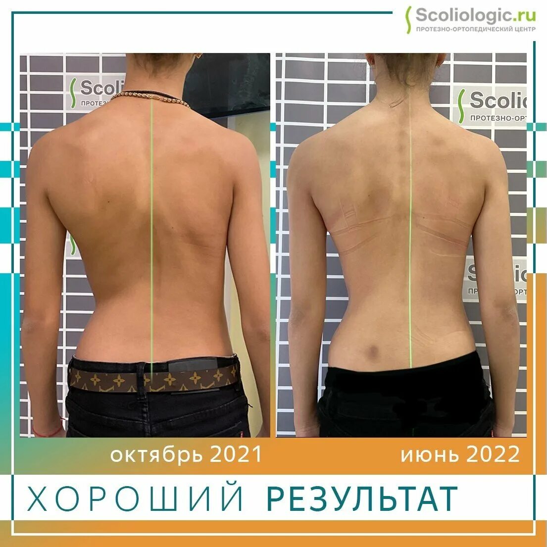 Центр лечения сколиоза и ортезирования
