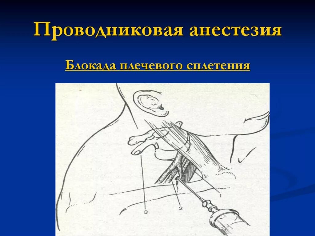 Обезболивающая блокада. Шейная блокада проводниковая анестезия. Паралюмбальная проводниковая анестезия. Проводниковая анестезия по Оберсту-Лукашевичу. Проводниковая (регионарная) анестезия.