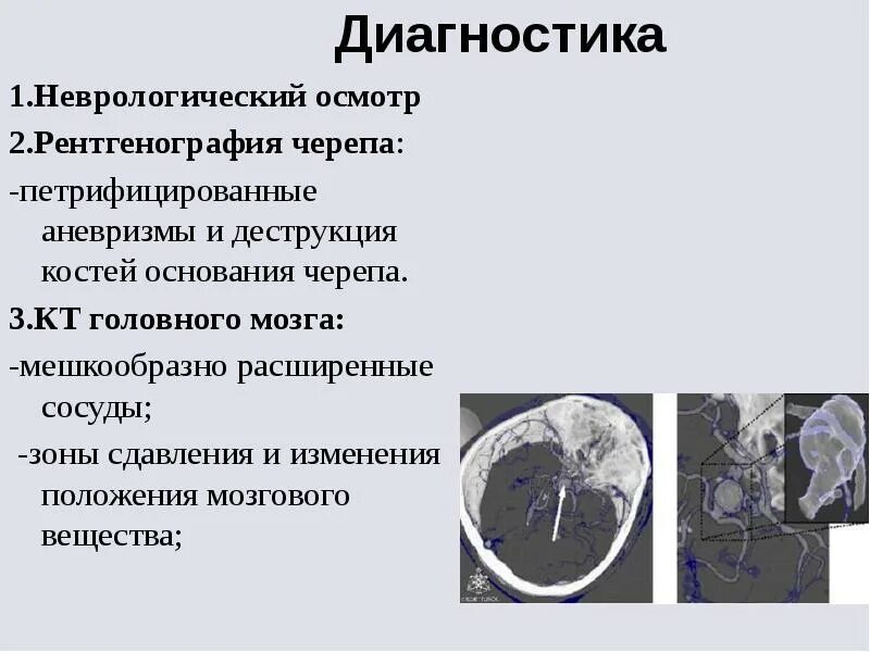 Аневризматическая болезнь головного. Симптомы разрыва аневризмы гм. Аневризма головного сосудов. Аневризматическая болезнь головного. Аневризматическая болезнь головного.