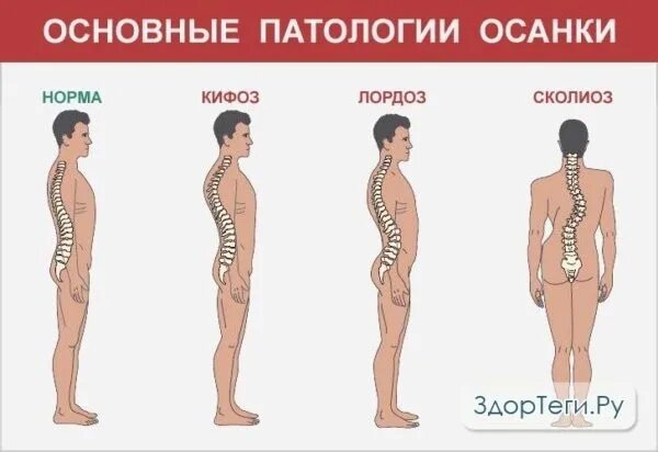 Нормальная поясница. Лордоз кифоз сколиоз. Нарушения осанки лордоз кифоз. Осанка лордоз кифоз сколиоз. Искривление позвоночника сутулость.