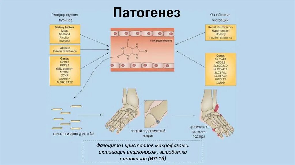 Подагра схема. Подагра механизм развития биохимия. патогенез острого подагрического артрита. механизмы развития подагры схема.